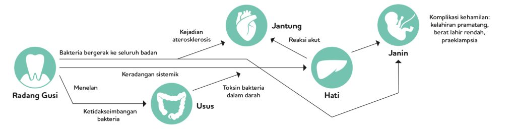 Pregnancy Periodontitis Diagram