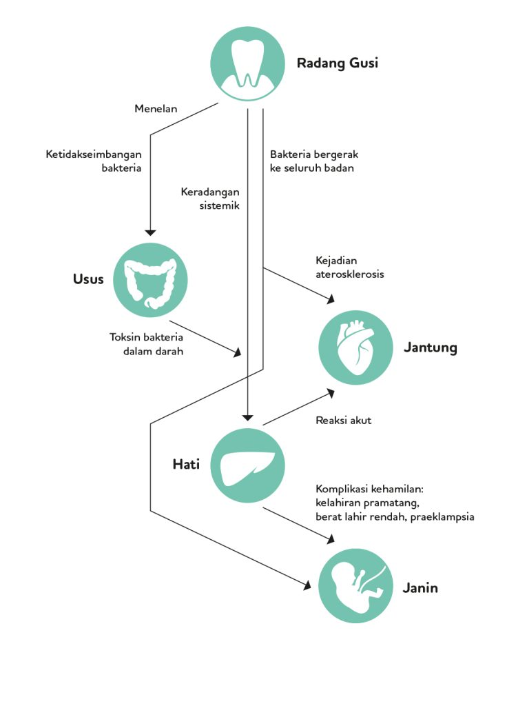 Pregnancy Periodontitis Diagram